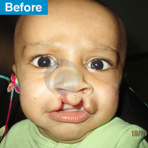 before-after