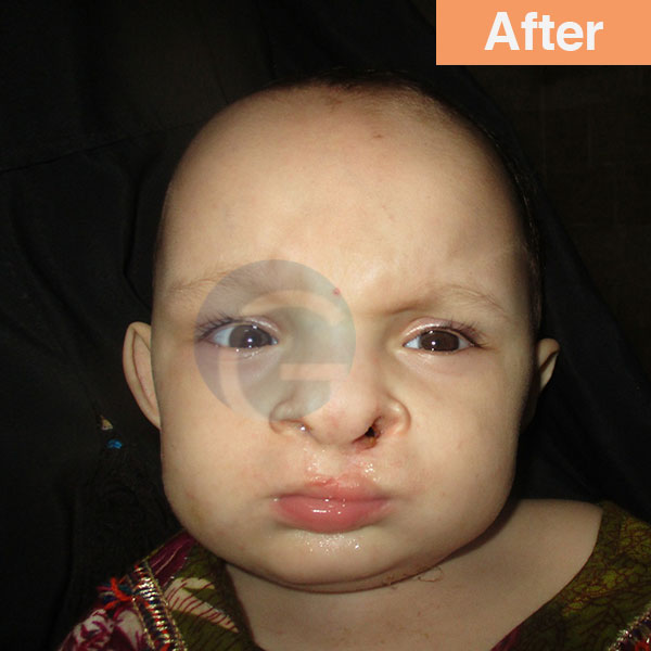 before-after