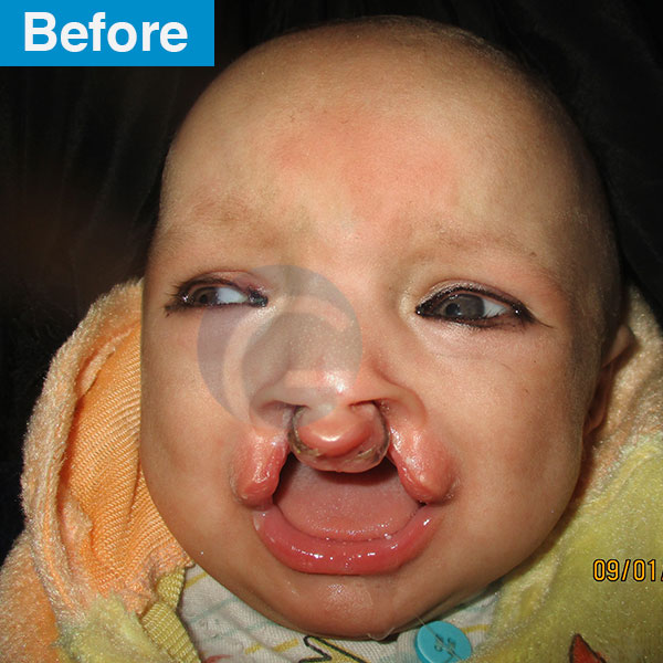 before-after