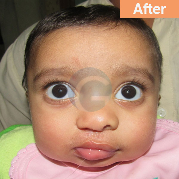 before-after