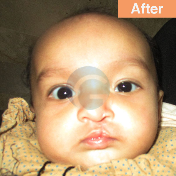 before-after