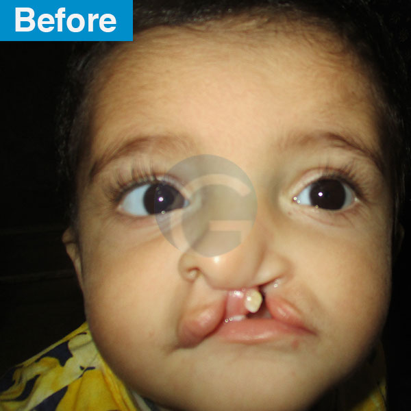 before-after