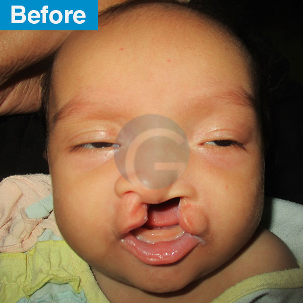 before-after