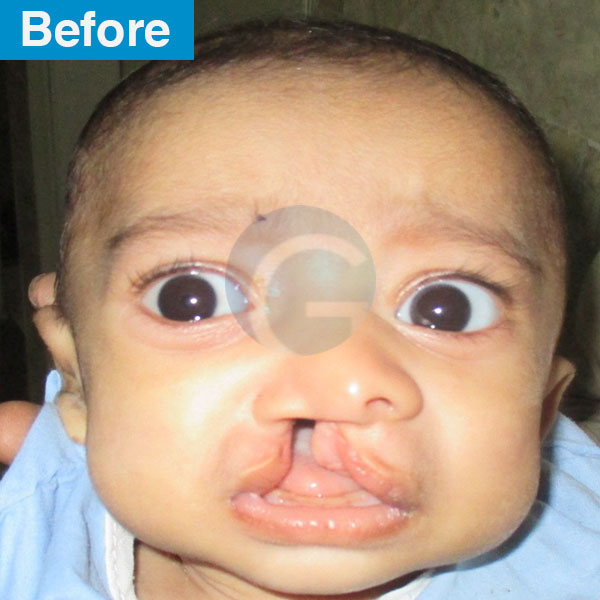 before-after