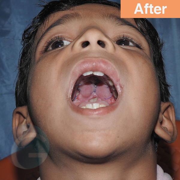 before-after