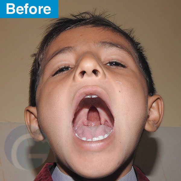 before-after