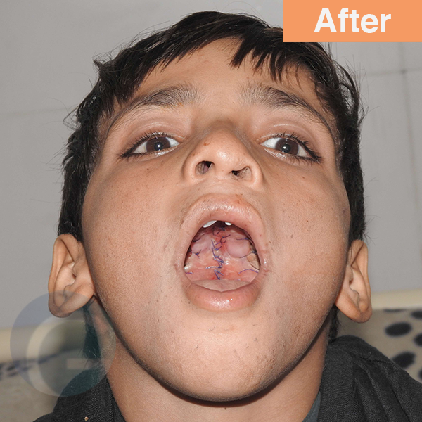 before-after