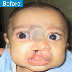 before-after
