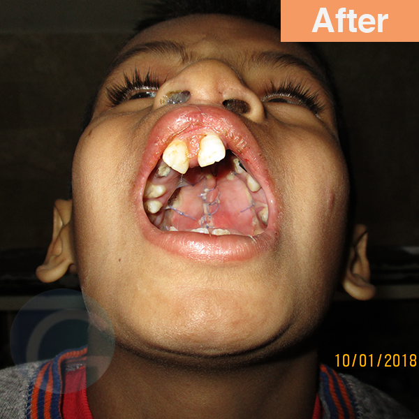 before-after