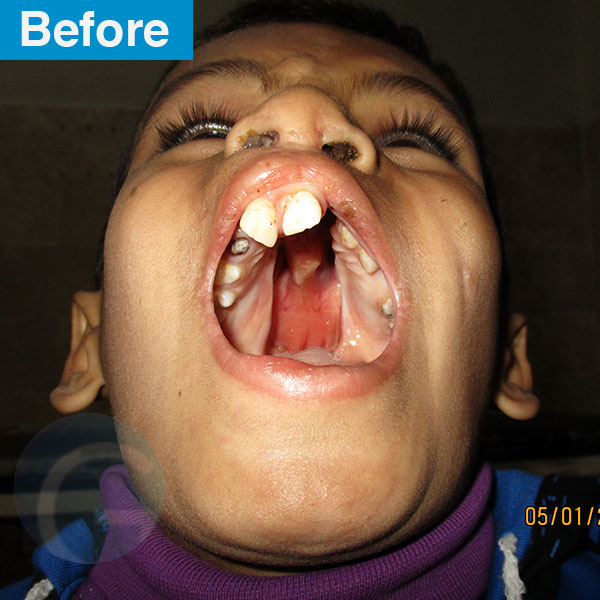 before-after