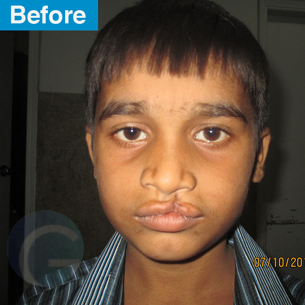 before-after