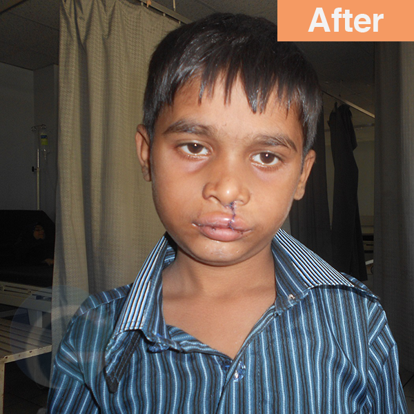 before-after