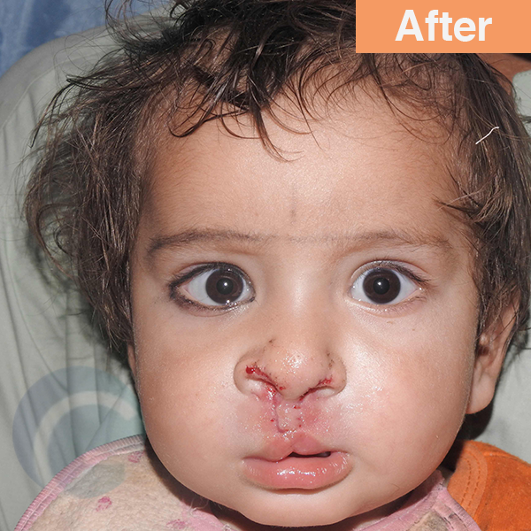 before-after