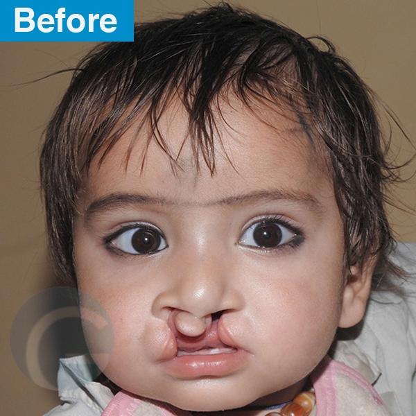 before-after