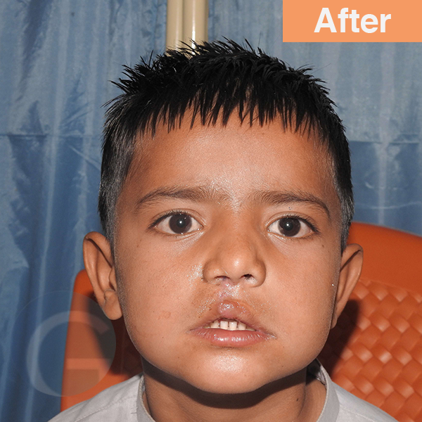 before-after