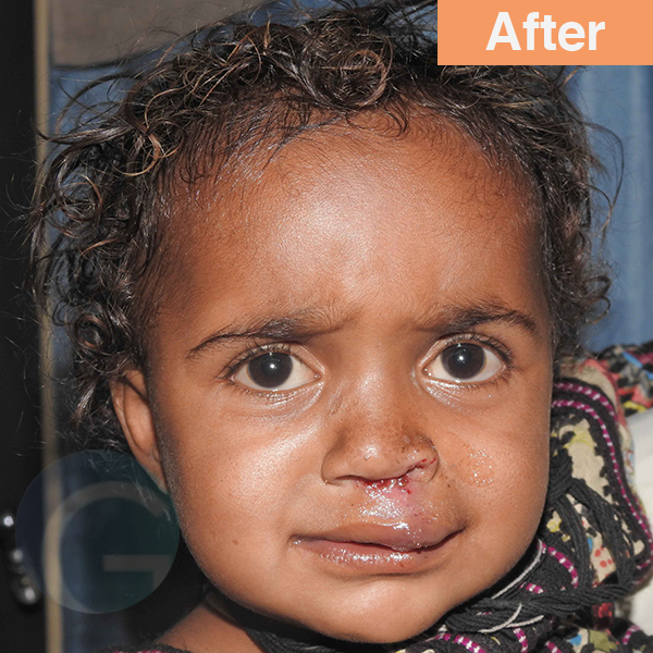 before-after